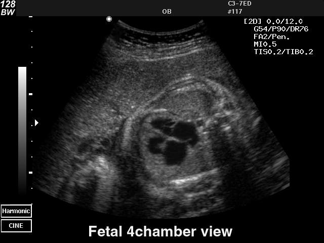 Fetal heart (4 chamber view), B-mode (echogramm №38)