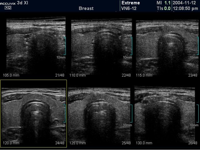 Thyroid, MSV (echogramm №380)