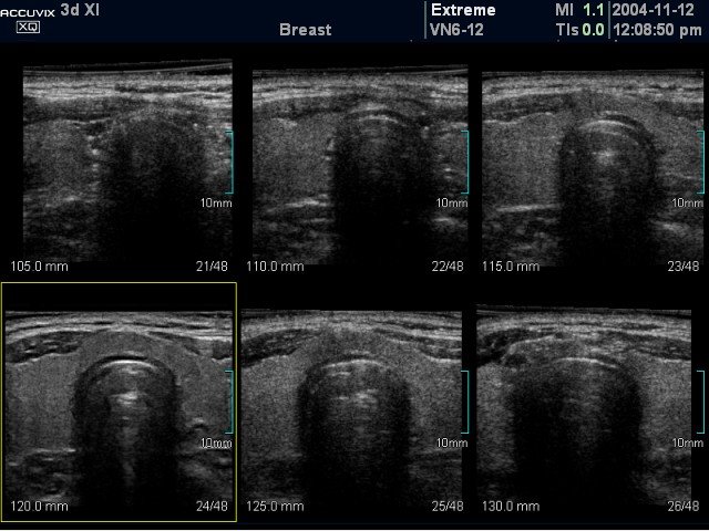 Thyroid, MSV (echogramm №380)