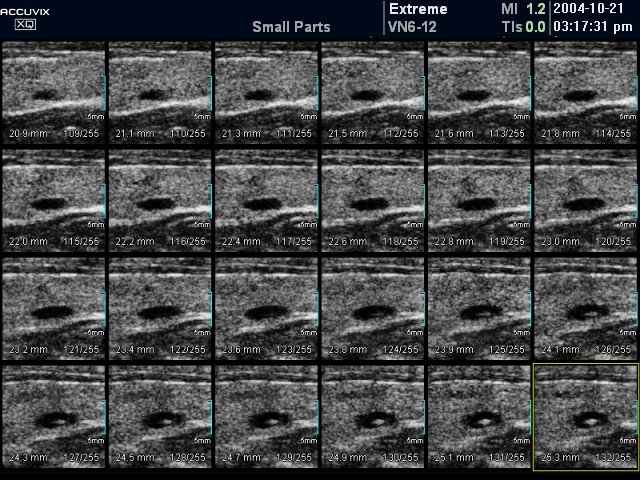 Thyroid mass, MSV (echogramm №381)