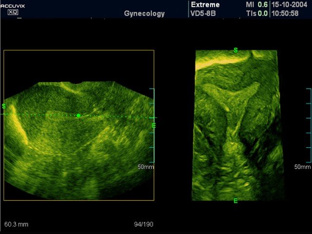 Uterus, OVIX & 3D (echogramm №382)