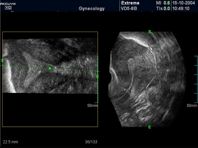 Uterus - oblique view, B-mode (echogramm №383)