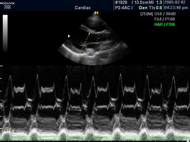 Mitral valve, anatomical M-mode  (echogramm №384)