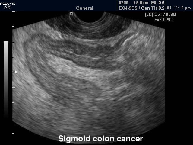 Sigmoid colon cancer, B-mode (echogramm №385)