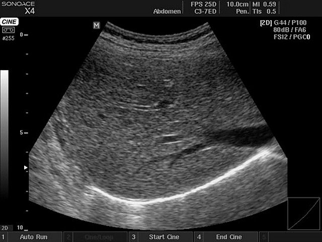 Liver, B-mode (echogramm №398)