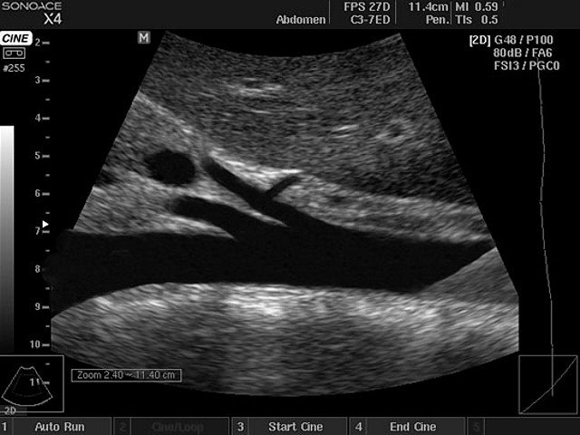Abdominal aorta, B-mode (echogramm №399)