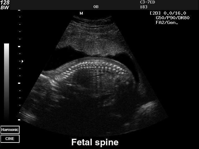 Fetal spine, B-mode (echogramm №40)