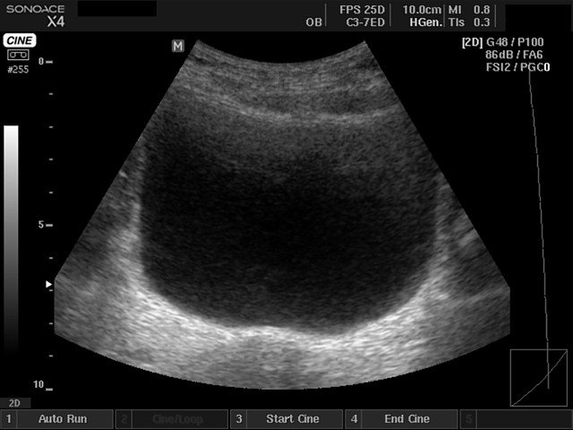 Bladder, B-mode (echogramm №400)