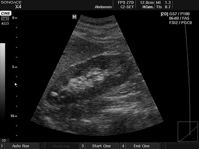 Kidney, B-mode (echogramm №402)