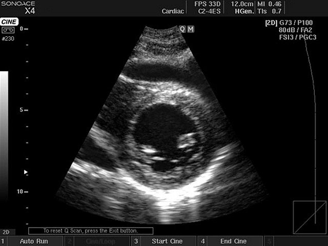 Heart (short axis of LV), B-mode (echogramm №403)