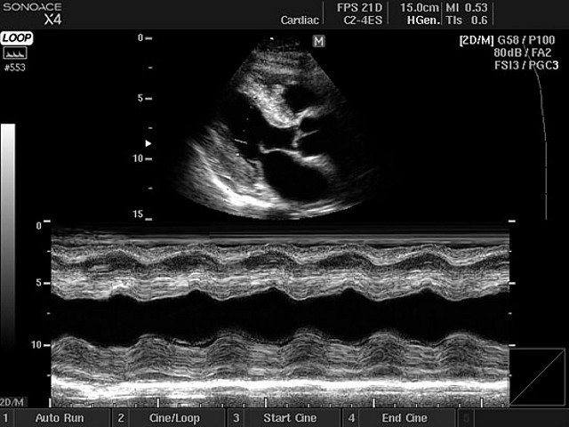 Heart - amyloidosis, M-mode (echogramm №404)