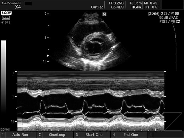 Mitral valve, M-mode (echogramm №407)