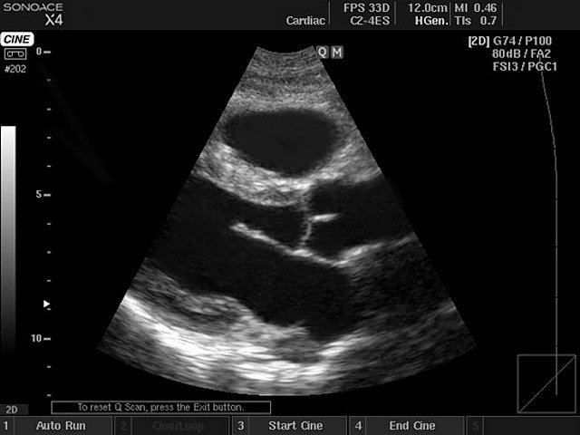 Heart (long axis of LV), B-mode (echogramm №408)