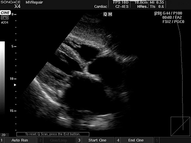 Heart (subcostal view), B-mode (echogramm №410)