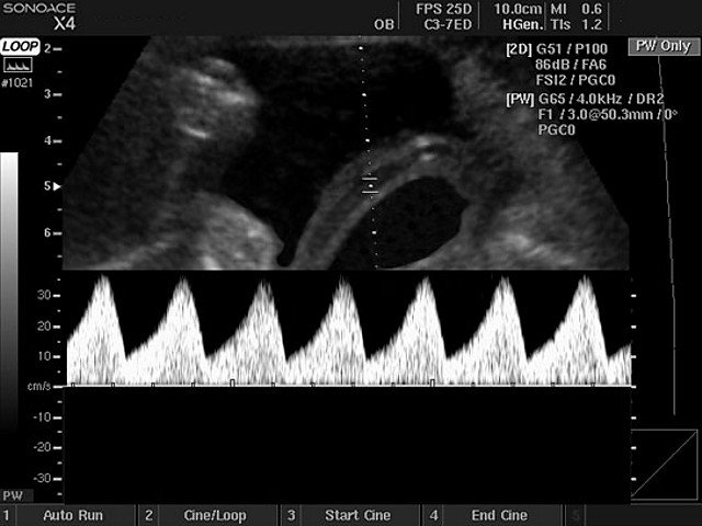 Umbilical cord, PW (echogramm №411)