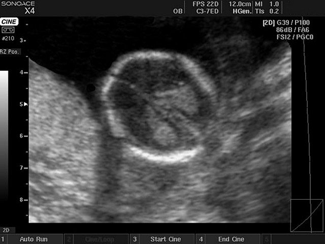 Fetal head, B-mode (echogramm №412)