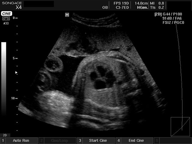 Fetus - heart, B-mode (echogramm №413)