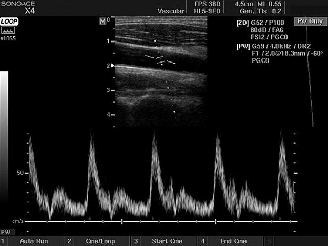 Common carotid artery, PW doppler (echogramm №417)