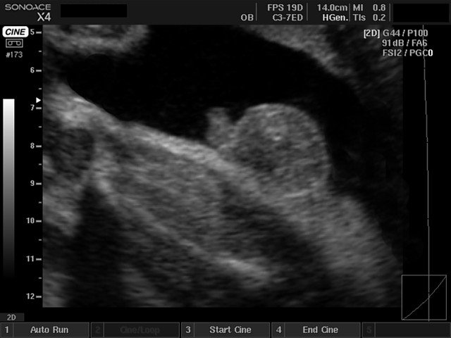 Fetal genitalia, B-mode (echogramm №418)