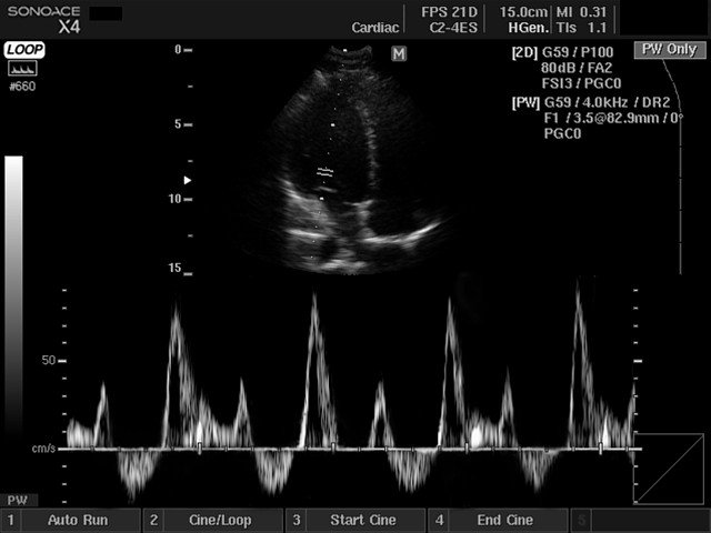 Heart - transmitral inflow, PW doppler (echogramm №419)