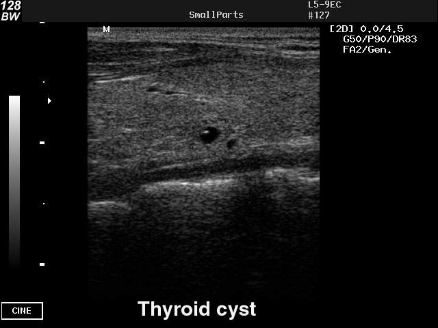 Thyroid cyst, B-mode (echogramm №42)