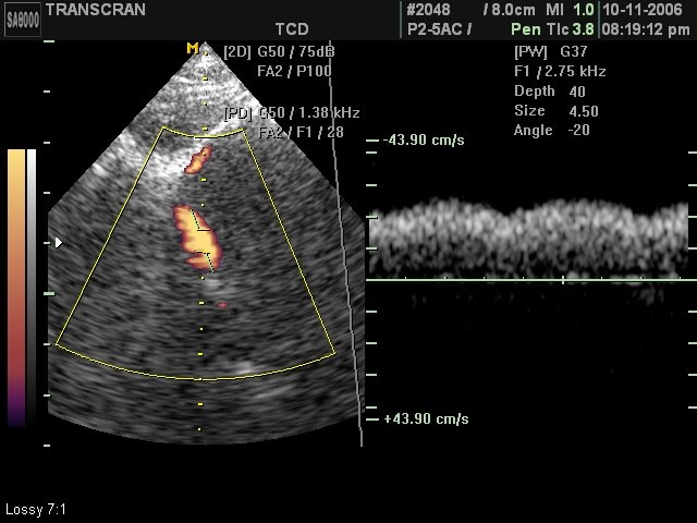 Medial cerebral artery, PD & PW (echogramm №420)