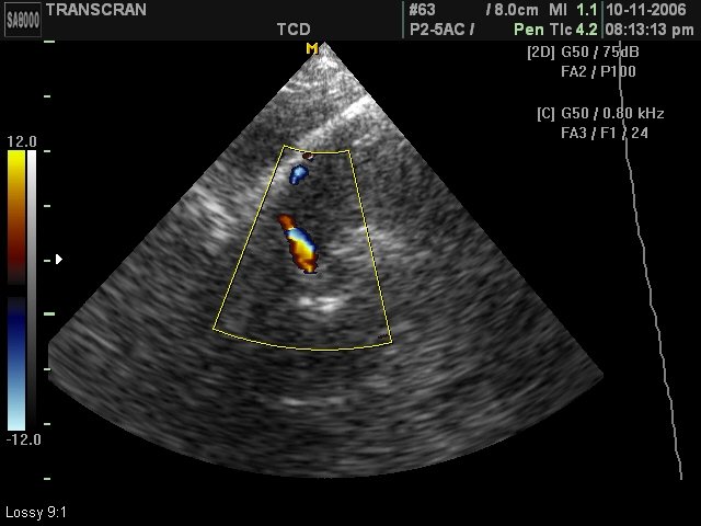 Medial cerebral artery, color doppler (echogramm №421)