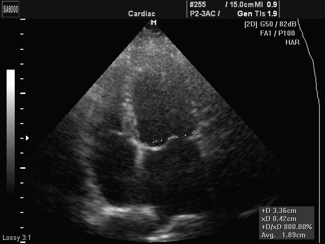 Mitral valve prolapse, B-mode (echogramm №422)