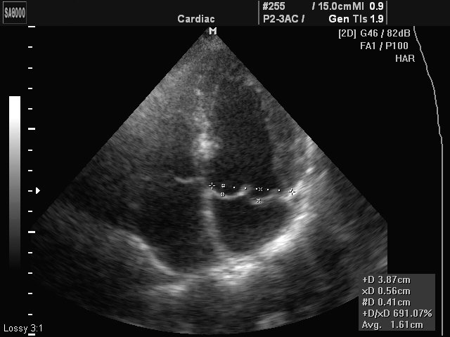 Mitral valve - myxomatous degeneration of cuspis, B-mode (echogramm №423)