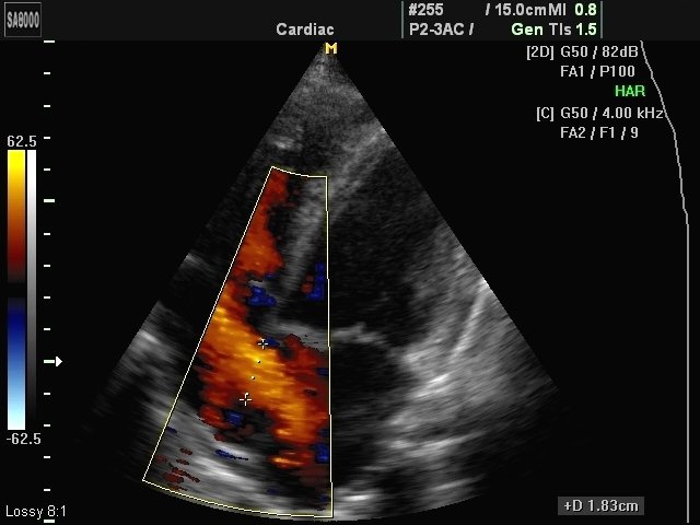 Interatrium septum defect, color doppler (echogramm №424)