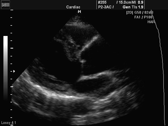 Aneurismus ascendus aorta, B-mode (echogramm №425)