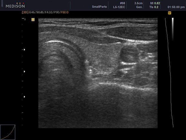 Thyroid, B-mode (echogramm №431)