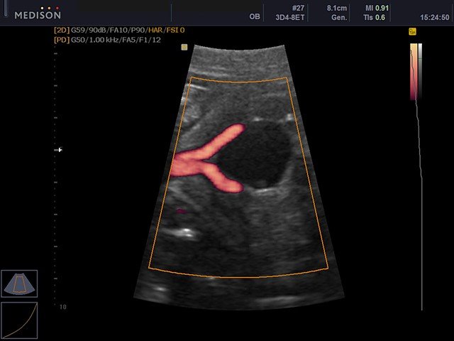 Artery of umbilical cord, power doppler (echogramm №433)