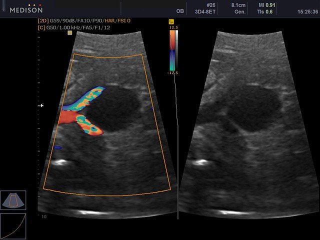 Artery of umbilical cord, directional power doppler (echogramm №434)