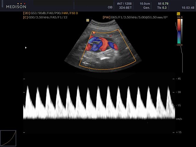 Umbilical cord, CFM & PW (echogramm №435)