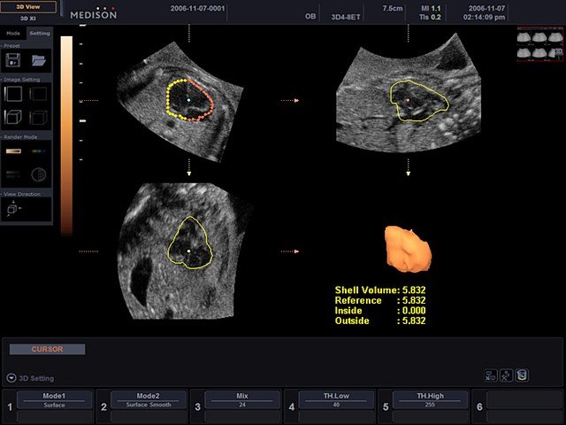 Fetal heart, VOCAL programm (echogramm №436)