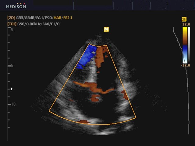 Heart, tissue doppler (echogramm №437)