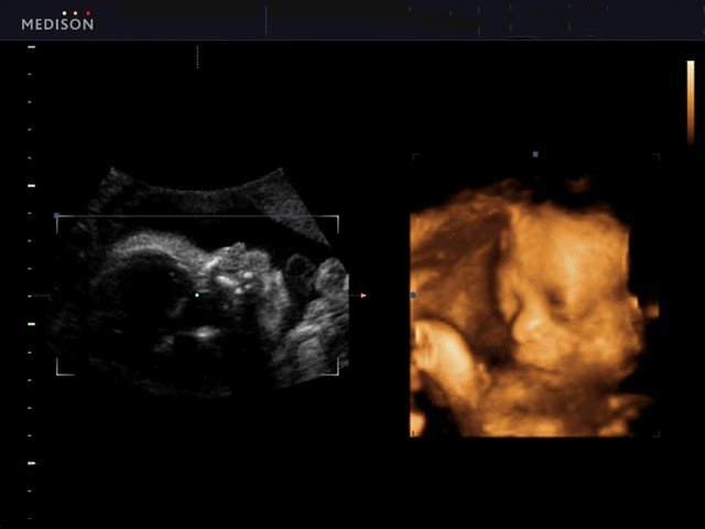 Fetus, 3D (echogramm №438)