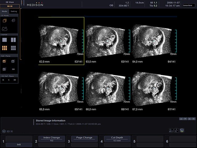 Fetal brain, MSV (echogramm №439)