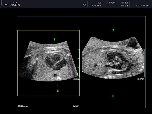 Fetal heart - oblique view, B-mode (echogramm №440)
