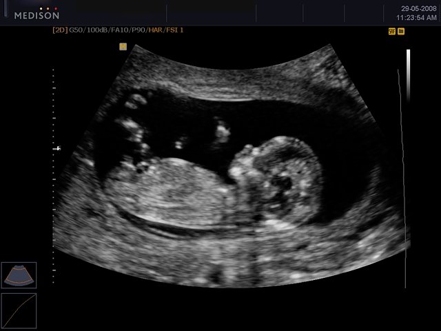 Fetus - 12 weeks, B-mode (echogramm №442)