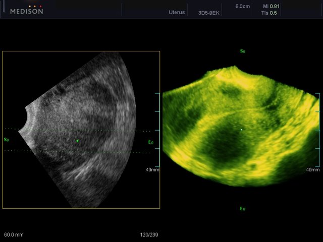 Uterus, OVIX & 3D (echogramm №443)