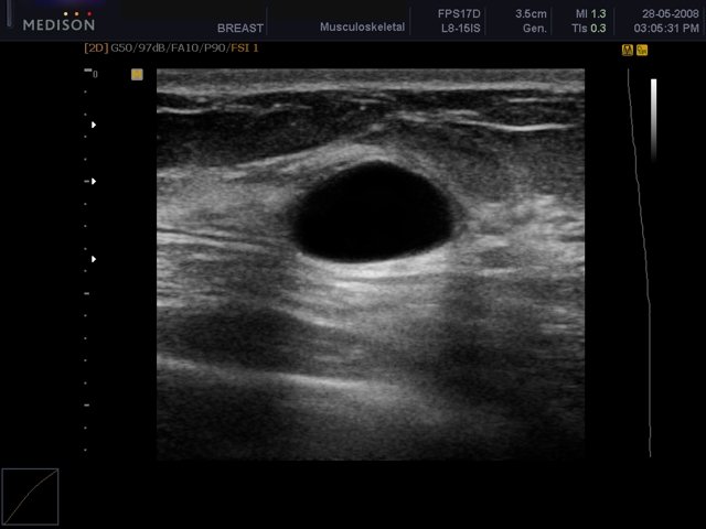 Breast - cyst, DMR (echogramm №444)