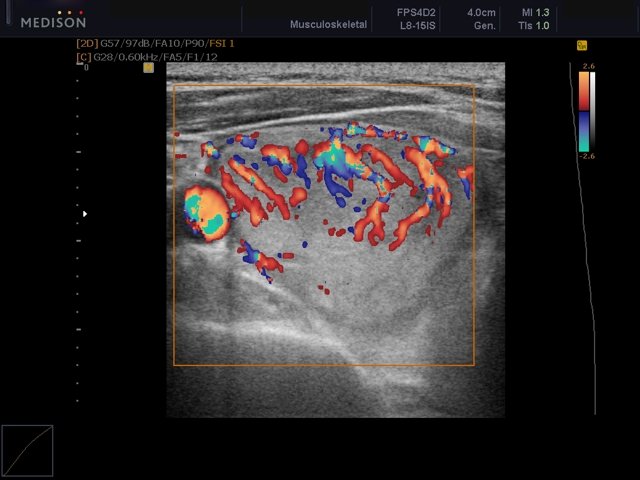 Thyroid nodule, color doppler (echogramm №445)