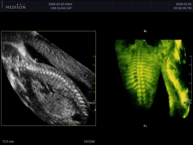 Fetal spine, OVIX & 3D (echogramm №448)