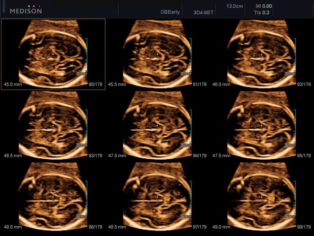 Fetal brain, MSV (echogramm №449)