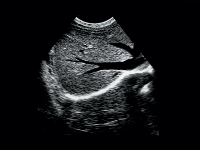 Liver and hepatic veins, B-mode (echogramm №45)