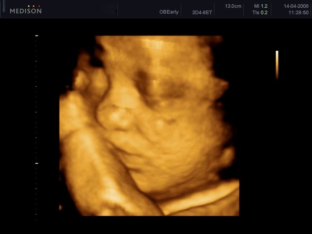 Fetal face - 29 weeks, 3D (echogramm №450)