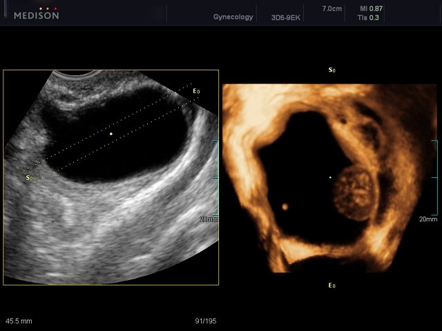 Ovarian mass, OVIX, 3D (echogramm №451)