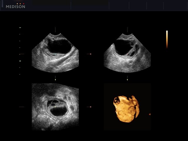 Ovarian cyst, inversion 3D (echogramm №452)